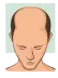 Stage 2 : Hair fall solution