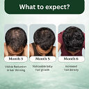 Stage 4 : Hair fall solution